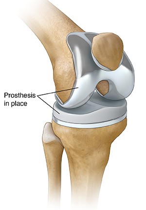 Total Knee Replacement Diagram